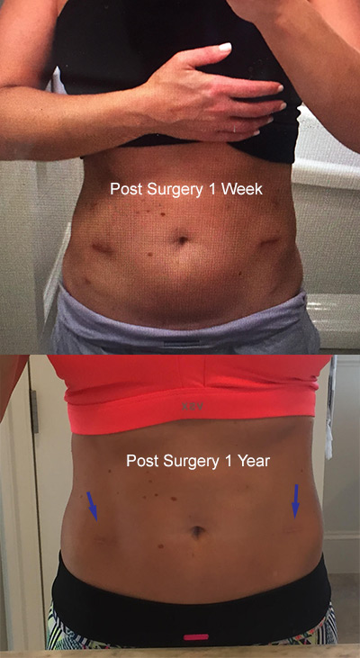 1 week and 1 year post ELS surgery