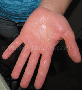 Top Causes, Cure and Treatments for Hyperhidrosis of The Hands and Palms, Best for Palmar Hyperhidrosis Near Me, How To Treat Your Skin and Sweaty Palms - Los Angeles California