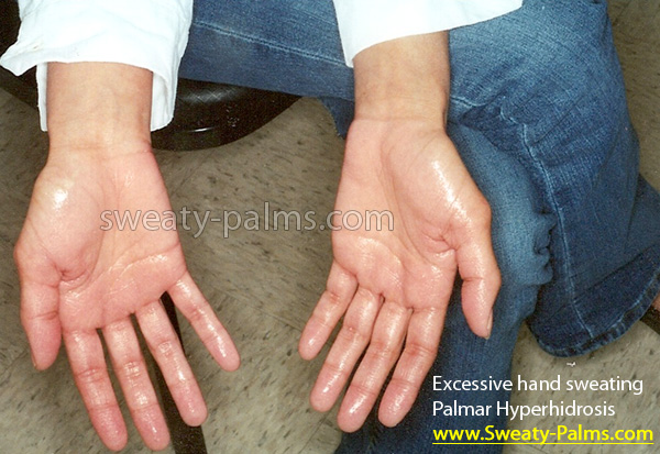 Causes Cure And Treatments For Hyperhidrosis Of The Hands And Palms